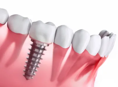 Dentadura con una muela con implante
